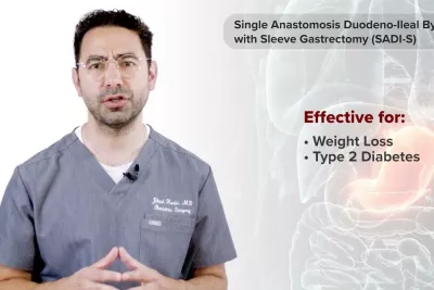 Single Anastomosis Duodeno-Ileal Bypass with Sleeve Gastrectomy (SADI-S) with Dr. Jihad Kudsi