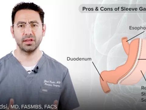 Pros & Cons of Sleeve Gastrectomy with Dr. Jihad Kusdi, MD, FASMBS, FACS